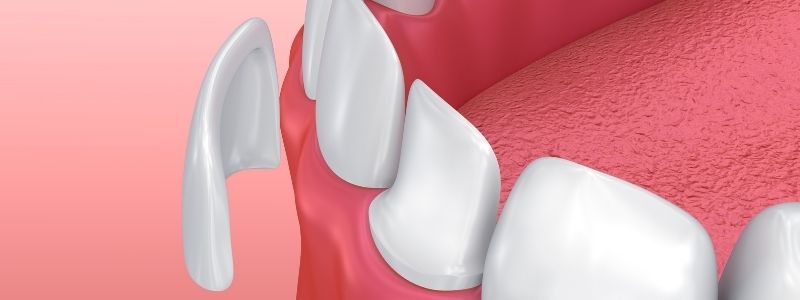 What Happens to Your Teeth Under Veneers