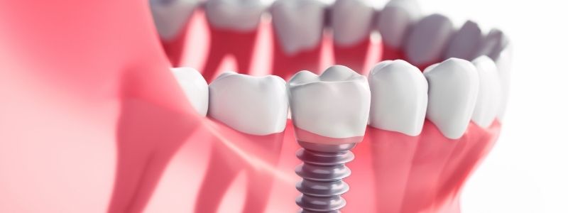 How Much Do Dental Implants Cost