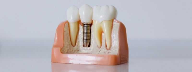 Full Mouth Dental Implants Cost